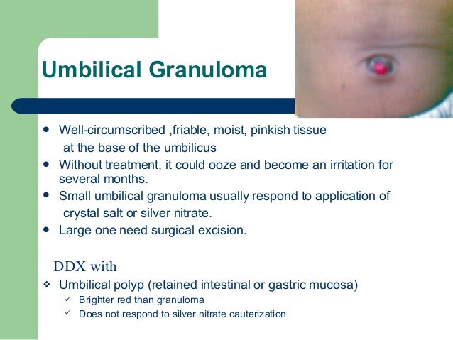 umbilical granuloma silver nitrate application